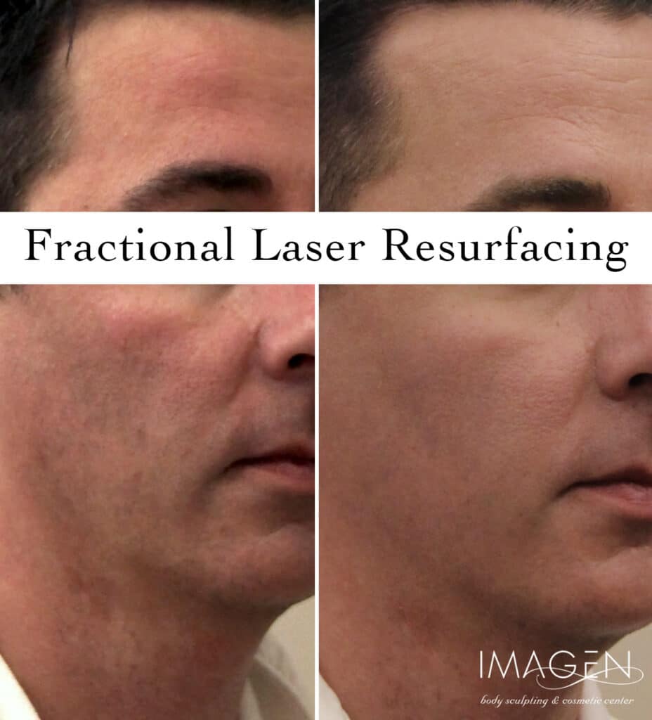 Pearl Fractional Laser Resurfacing Omaha Cosmetic Center by Imagen