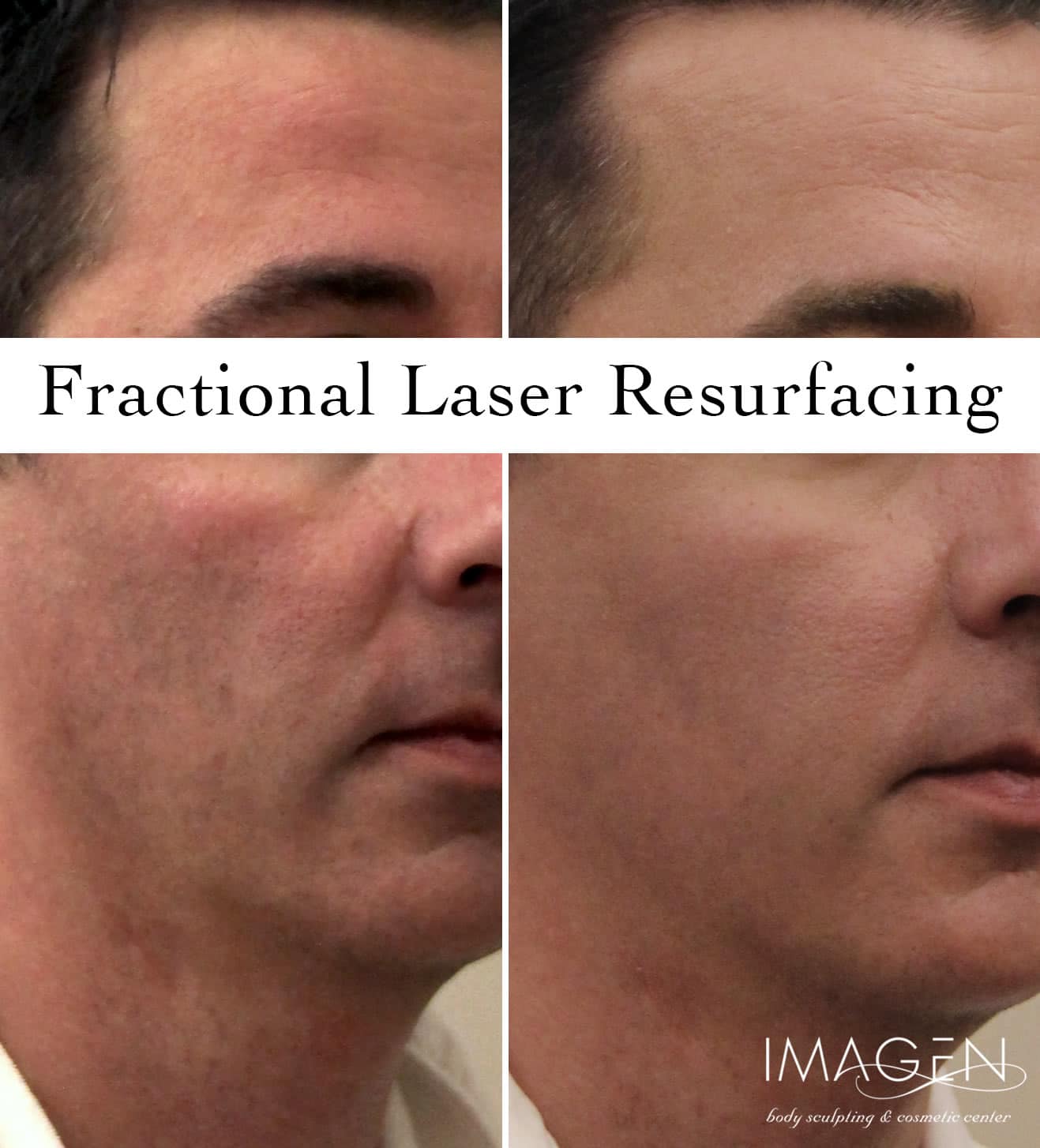 Laser Fractional Resurfacing For Skin Rejuvenation