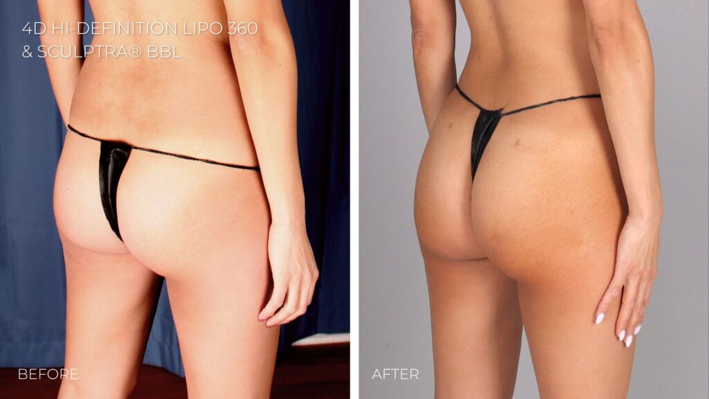 BBL [Before & After] - Body Sculpting with Orthosculpt