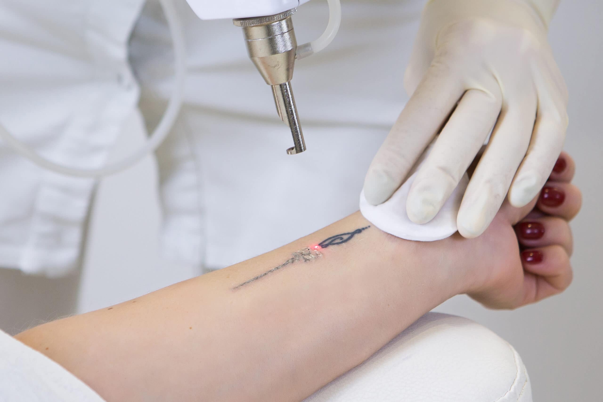 A Closer Look at Options for Optimal Tattoo Removal